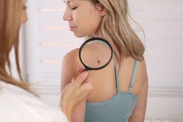 What Are Traditional Skin Lesion Removal Methods Windsor?