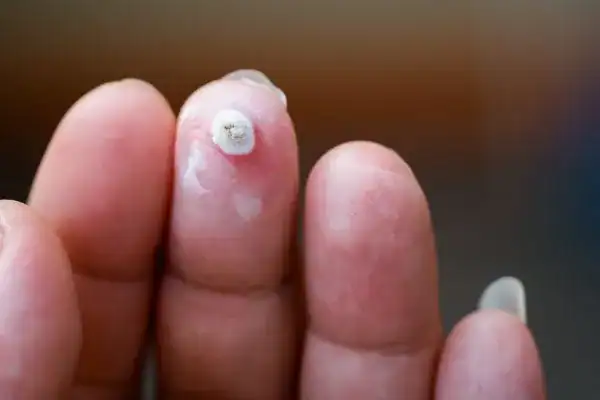 Image of white wart before cryopen treatment Windsor