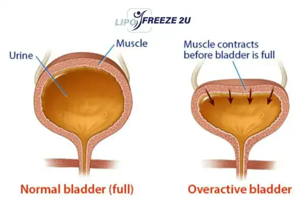 diagram of overactive bladder treatment Windsor