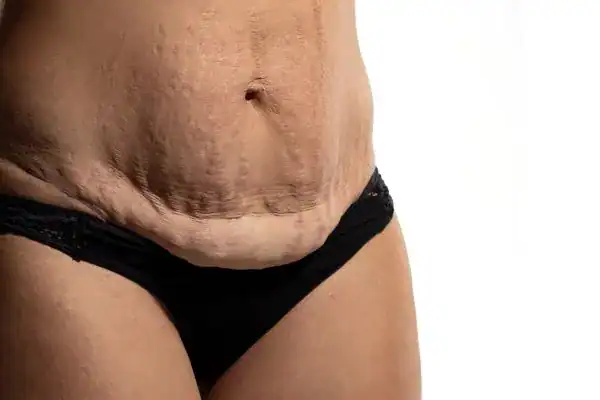loose skin after weight loss injections Windsor