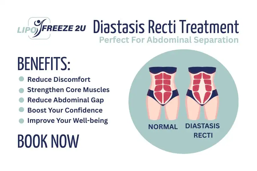 Benefits of body toning treatment Windsor for Diastasis recti