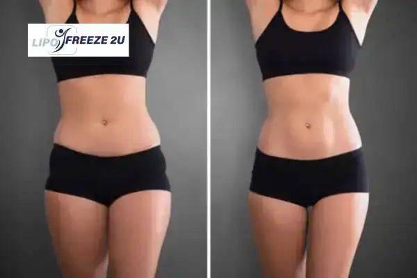 How Can LIPO FREEZE 2U Support Your Post-Pregnancy Body Recovery Windsor?