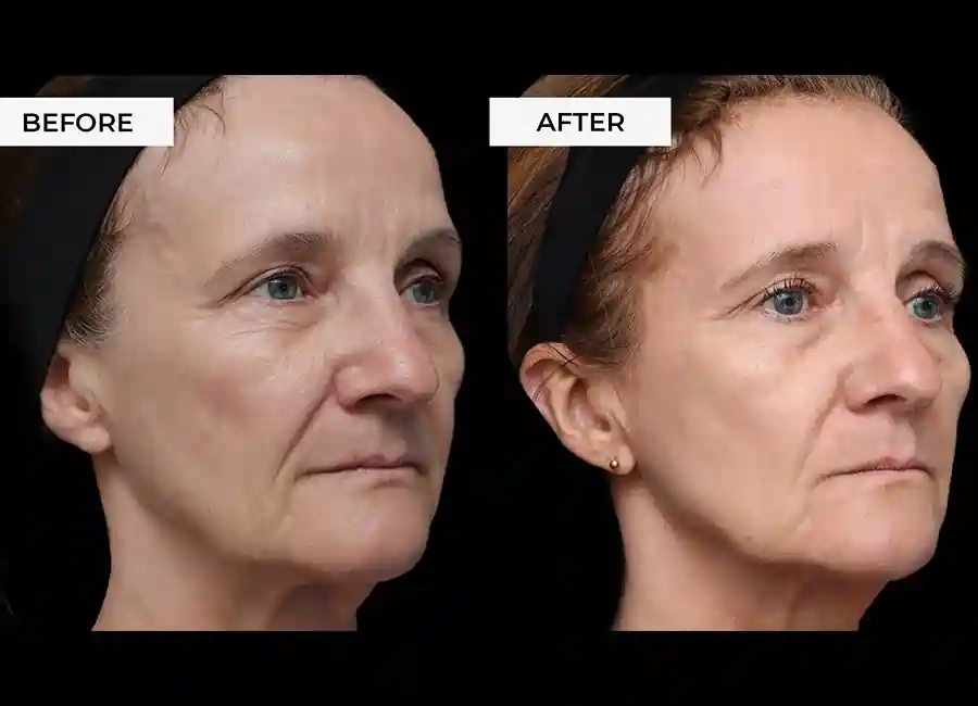 How Many RF Microneedling Sessions Will You Need to See a Difference Windsor?
