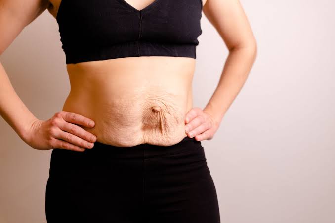 Is Surgery Really the Only Way to Repair Diastasis Recti Windsor?