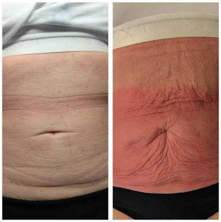 How Does RF Microneedling Improve Crepey, Thin and Uneven Skin Texture Windsor?