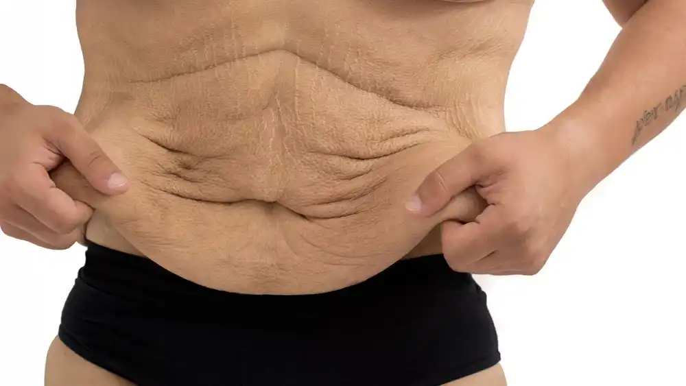 RF Microneedling for Loose Skin: How Can It Help Tighten and Reshape the Skin Windsor?